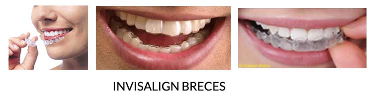 Invisible Braces service